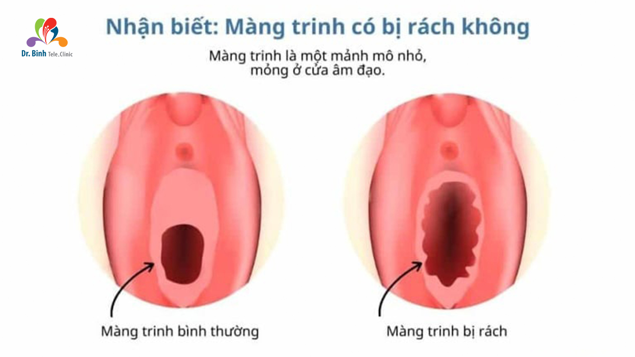 Biểu Hiện Của Rách Màng Trinh Gallery 1