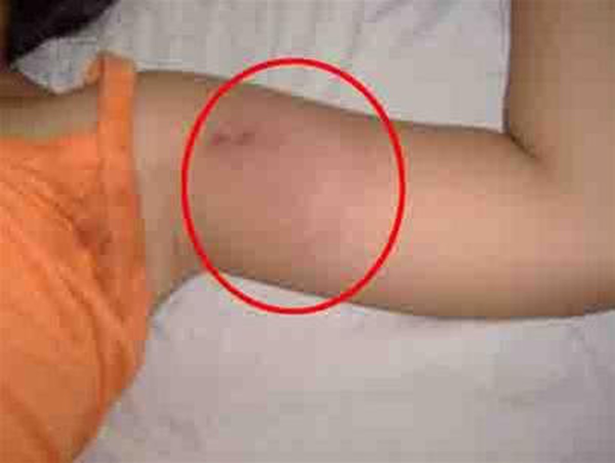 Dấu Răng Chuột Cắn: Nhận Biết, Phòng Tránh và Khắc Phục