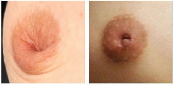Đầu Ti Bị Thụt: Nguyên Nhân, Triệu Chứng Và Cách Khắc Phục