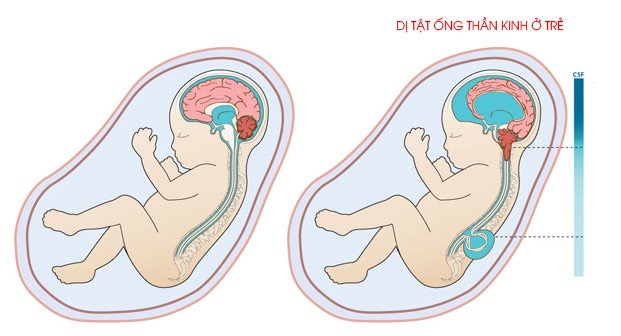 Những Dị Tật Bẩm Sinh Thường Gặp Gallery 2