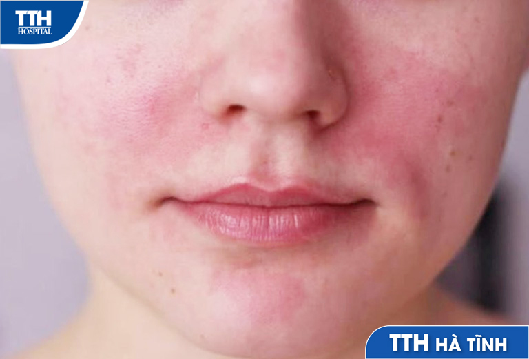 Dị ứng khẩu trang: Nguyên nhân, triệu chứng và cách khắc phục