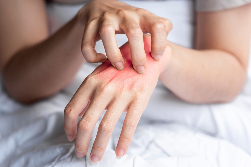 Dị ứng nước mưa là gì? Nguyên nhân, triệu chứng và cách điều trị