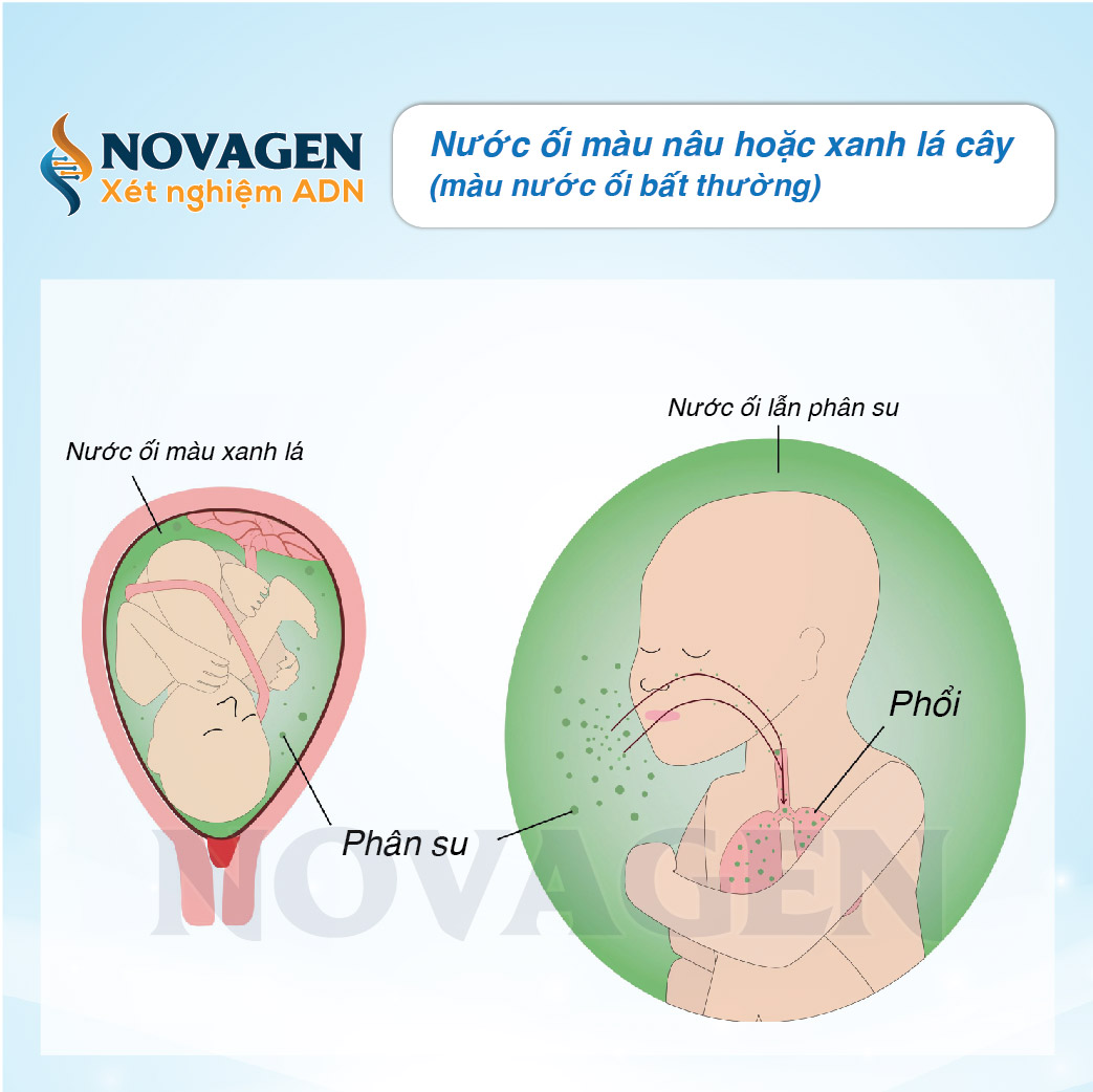 Nước ối màu xanh: Nguyên nhân và điều cần biết Gallery 2