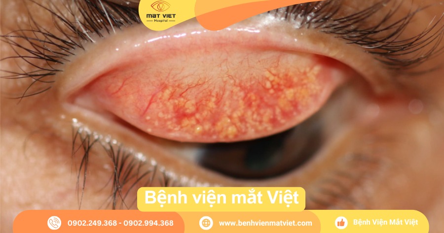 Lấy sạn vôi trong mắt bảo hiểm có hỗ trợ không? Gallery 1