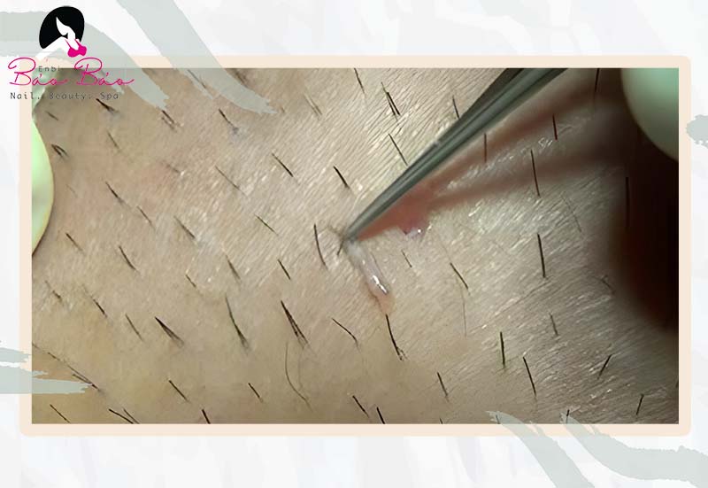Một Lỗ Chân Lông Mọc 2 Sợi Lông: Nguyên Nhân và Điều Trị Gallery 2