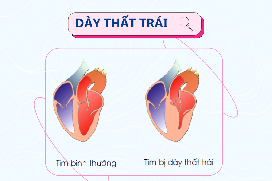 Thất Trái Tim Dày Có Chữa Khỏi Được Không? Gallery 2