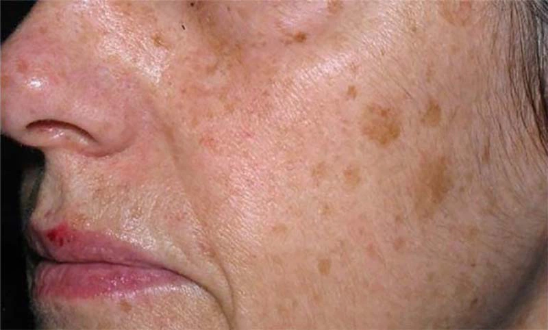 Đồi mồi ở người già: Nguyên nhân, triệu chứng và cách điều trị