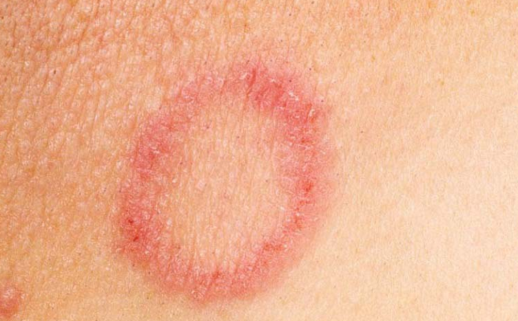 Đốm Bị Nổi Vòng Tròn Đỏ Trên Da: Nguyên Nhân, Triệu Chứng & Cách Điều Trị