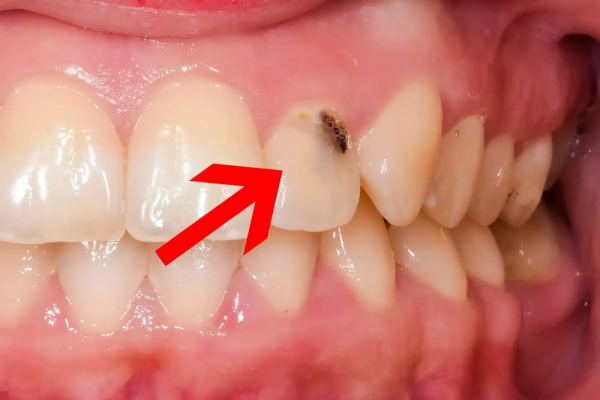 Đốm đen trên răng: Nguyên nhân, triệu chứng và cách điều trị
