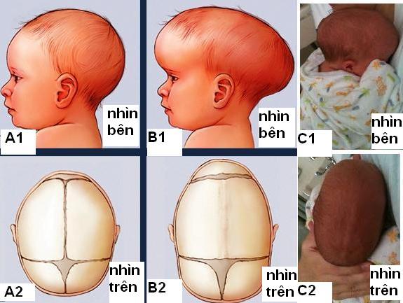Đóng thóp sớm là gì?