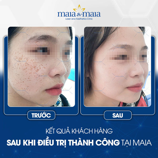 Đốt tàn nhang bao lâu thì hết thâm?