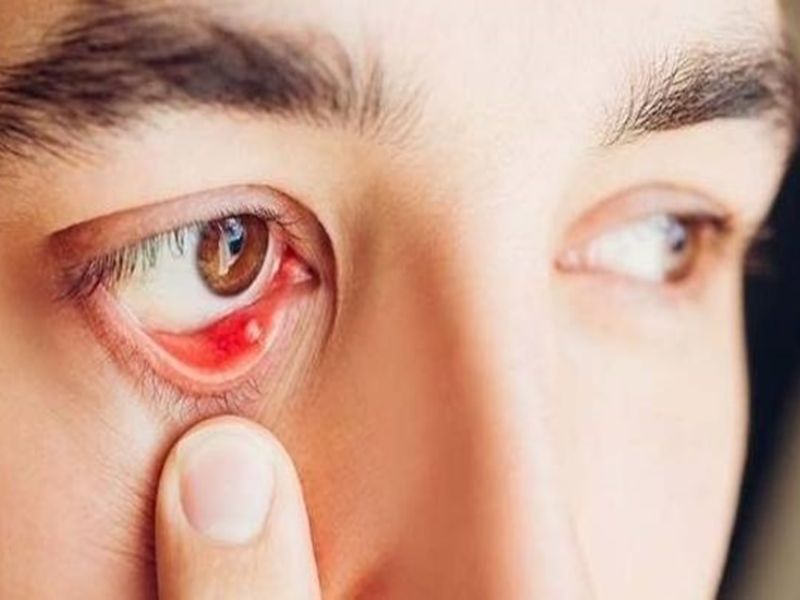 Dưới mí mắt có hạt trắng là bệnh gì?