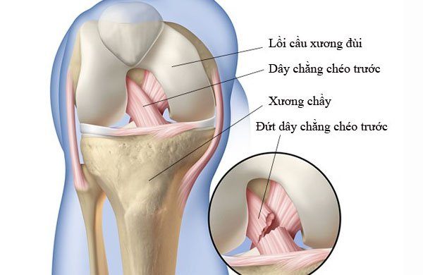 Đứt dây chằng có tự lành được không?