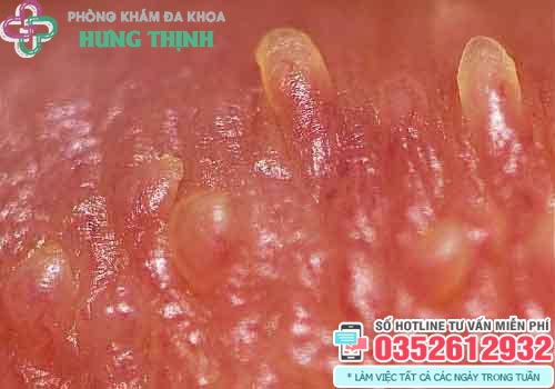 Gai Sinh Dục Thường Mọc Ở Đâu?