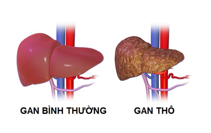 Gan cấu trúc thô là gì?
