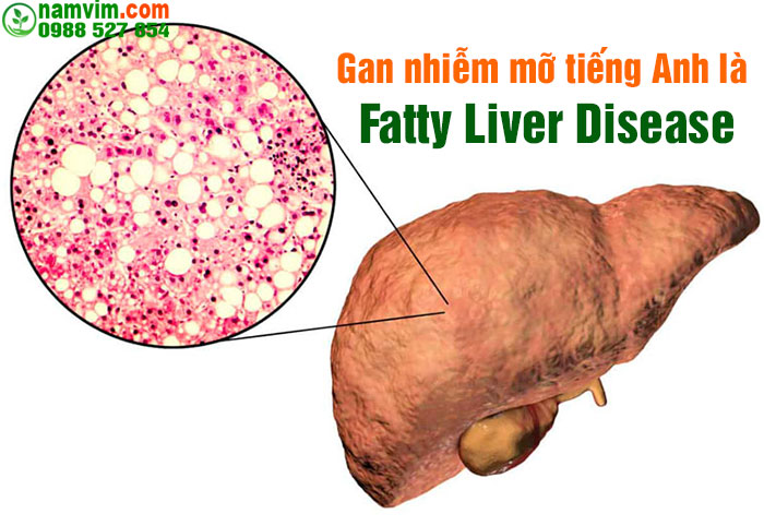 Gan Nhiễm Mỡ Tiếng Anh Là Gì