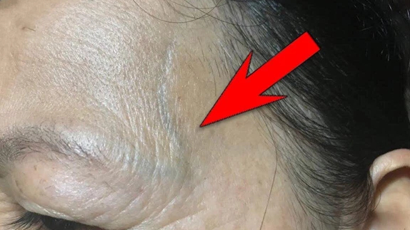 Gân Nổi Trên Trán: Nguyên Nhân Và Cách Khắc Phục