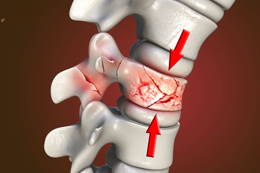 Gãy Đốt Sống Lưng Có Nguy Hiểm Không?