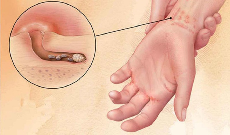 Ghẻ Lạnh Là Gì?