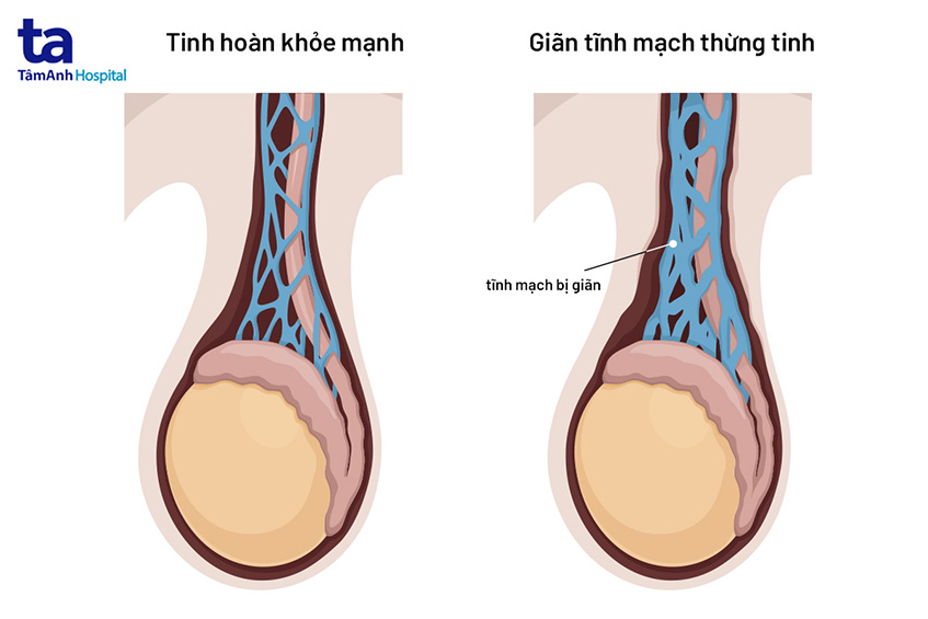 Giãn Thừng Tinh Là Gì?