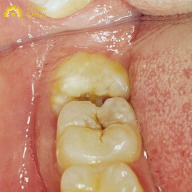 Giắt Răng: Hướng Dẫn Chi Tiết Từ A Đến Z