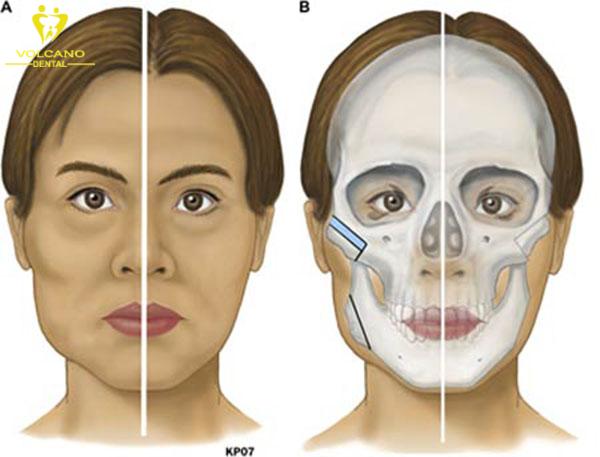 Gò Má Bên Cao Bên Thấp: Nguyên Nhân, Cách Khắc Phục và Điều Trị