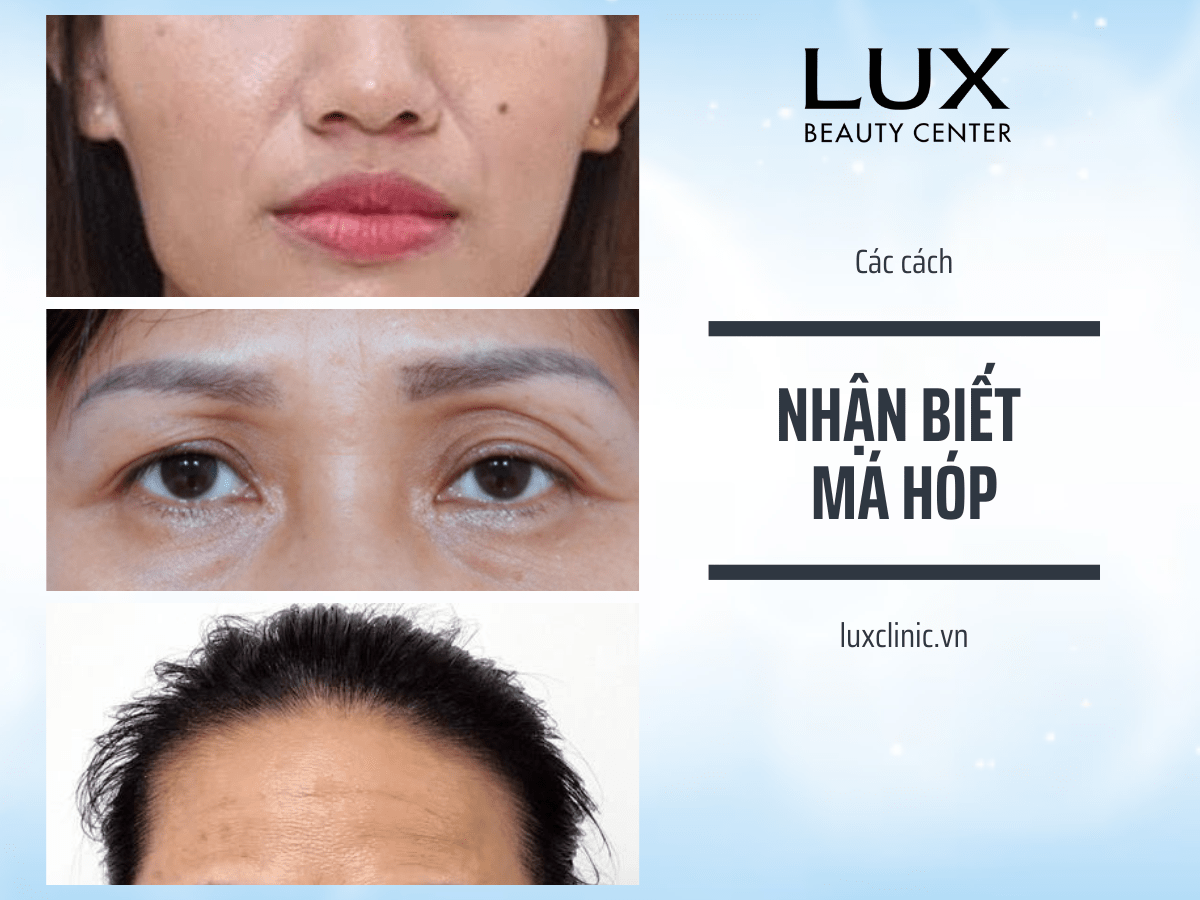 Gò má đầy đặn là như thế nào? Gallery 2