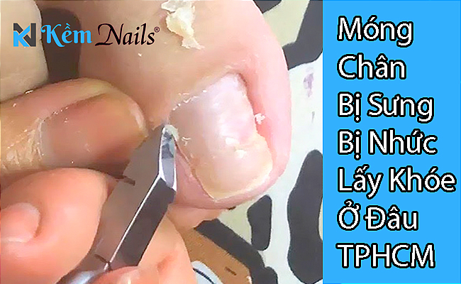 Lấy khóe móng chân ở đâu TPHCM? Gallery 2