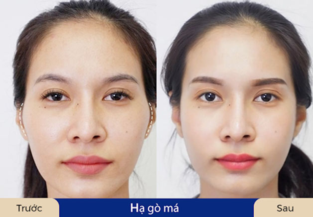 Hạ gò má bao lâu thì lành?