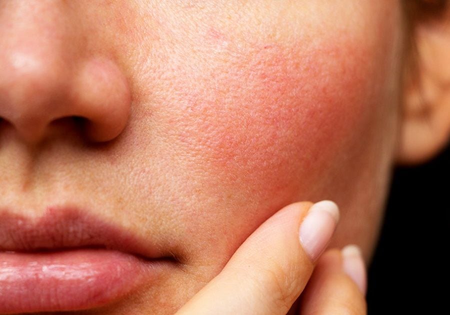 Hai Bên Má Bị Đỏ Rát: Nguyên Nhân và Cách Khắc Phục