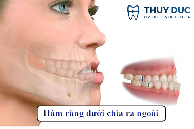 Hàm Răng Dưới Chìa Ra Ngoài: Nguyên Nhân và Cách Khắc Phục