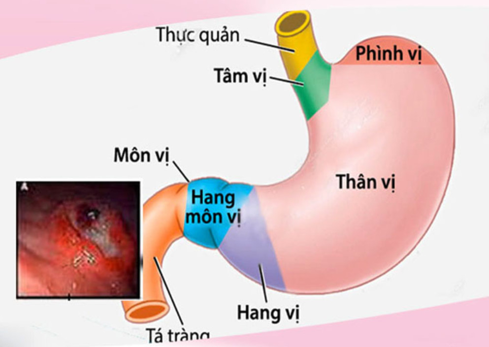 Viêm Niêm Mạc Hang Vị: Nguyên Nhân, Triệu Chứng & Điều Trị