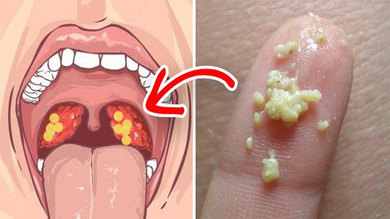 Hạt Trắng Trong Cổ Họng Có Mùi Hôi: Nguyên Nhân Và Cách Khắc Phục