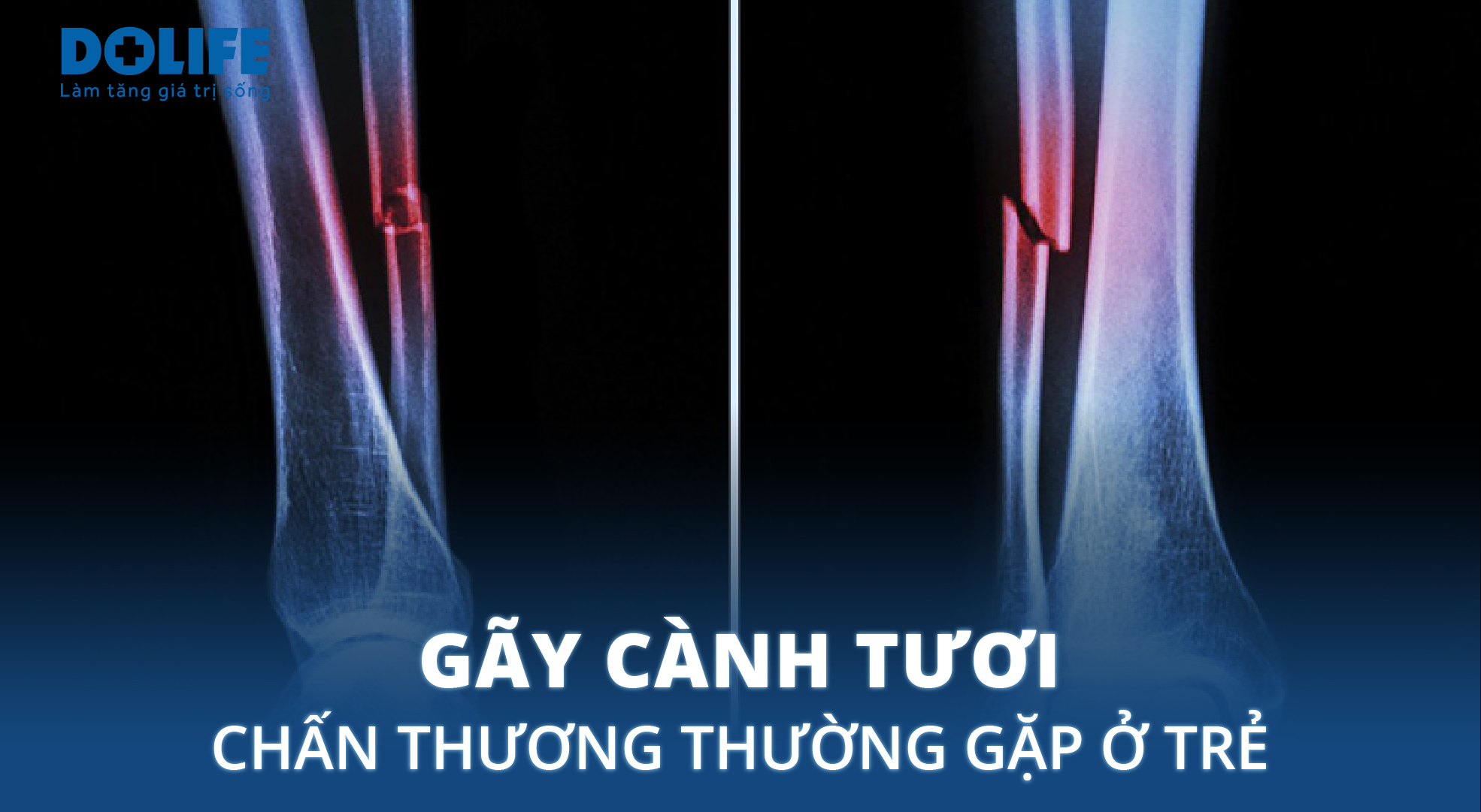 Gãy Cành Tươi Là Gì? Gallery 2