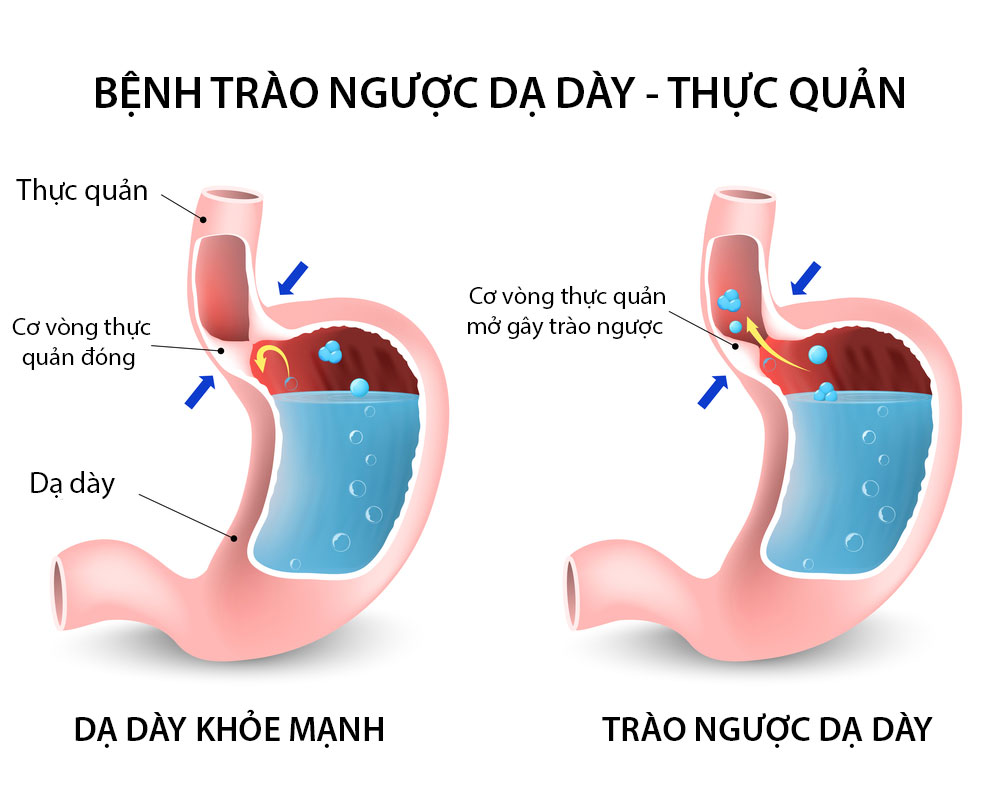 Hội chứng trào ngược là gì?