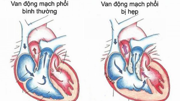 Hẹp Van Động Mạch Phổi