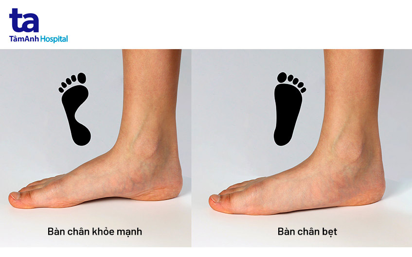 Bàn Chân Bẹt: Nguyên Nhân, Triệu Chứng Và Cách Điều Trị