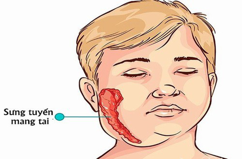 Quai bị là gì? Triệu chứng, điều trị và phòng ngừa