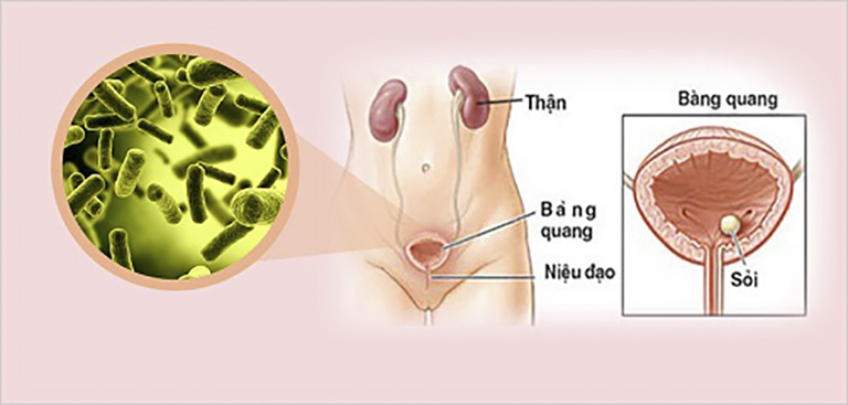 Đái Dắt Là Gì? Nguyên Nhân Và Cách Điều Trị