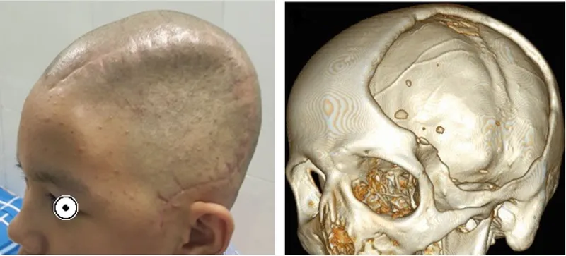 Lõm Đầu Ở Người Lớn: Nguyên Nhân, Triệu Chứng Và Điều Trị