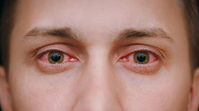 Mắt Cay Xè: Nguyên Nhân và Cách Khắc Phục