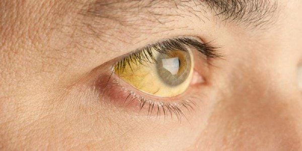 Mắt Nhìn Thấy Màu Vàng: Nguyên Nhân Và Cách Xử Lý