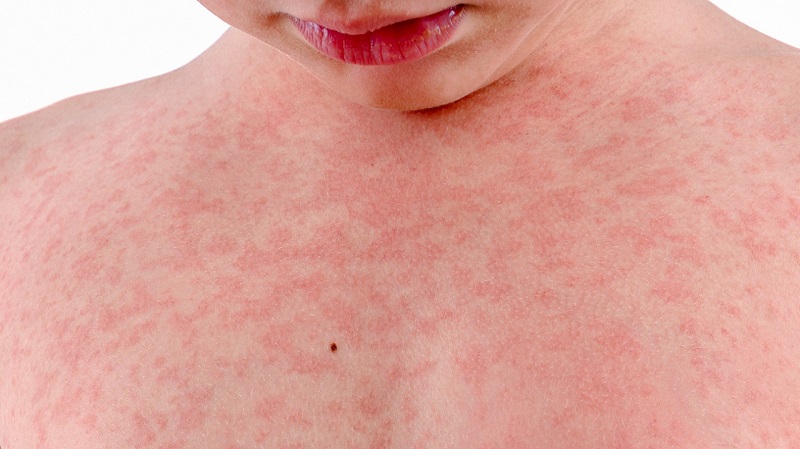 Nổi Mẩn Đỏ Ngứa Trên Da: Nguyên Nhân, Triệu Chứng & Cách Điều Trị