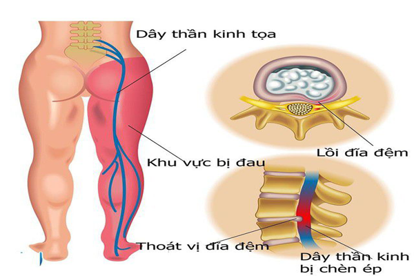 Tê Một Bên Chân: Nguyên Nhân và Cách Khắc Phục