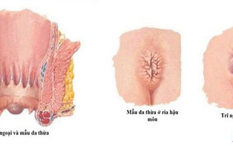Trẻ Kêu Đau Hậu Môn: Nguyên Nhân, Triệu Chứng Và Cách Xử Lý