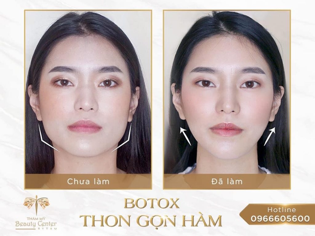 Tiêm Thon Gọn Mặt Gallery 1