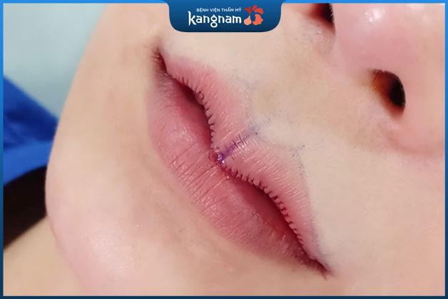 Cắt môi trái tim có được vĩnh viễn không? Gallery 1
