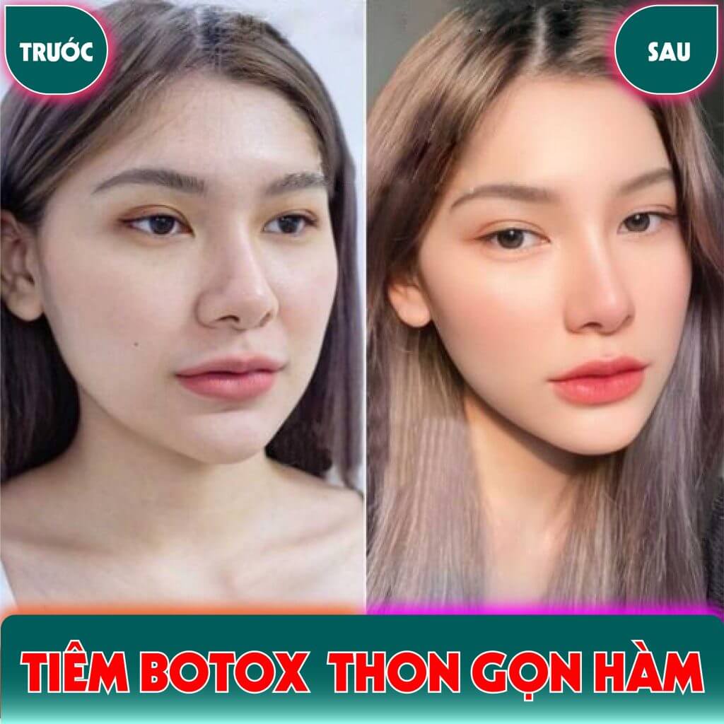 Tiêm Gọn Hàm Bao Lâu Thì Gọn? Gallery 1
