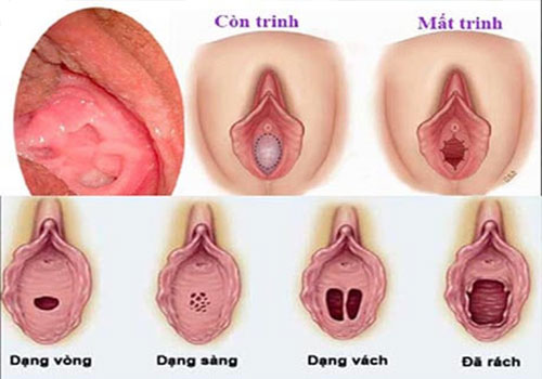 Màng trinh có lành lại được không? Gallery 1