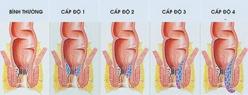 Tại Sao Ngồi Nhiều Bị Trĩ? Gallery 1